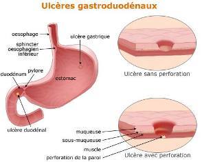 Ulcre gastro-duodnal